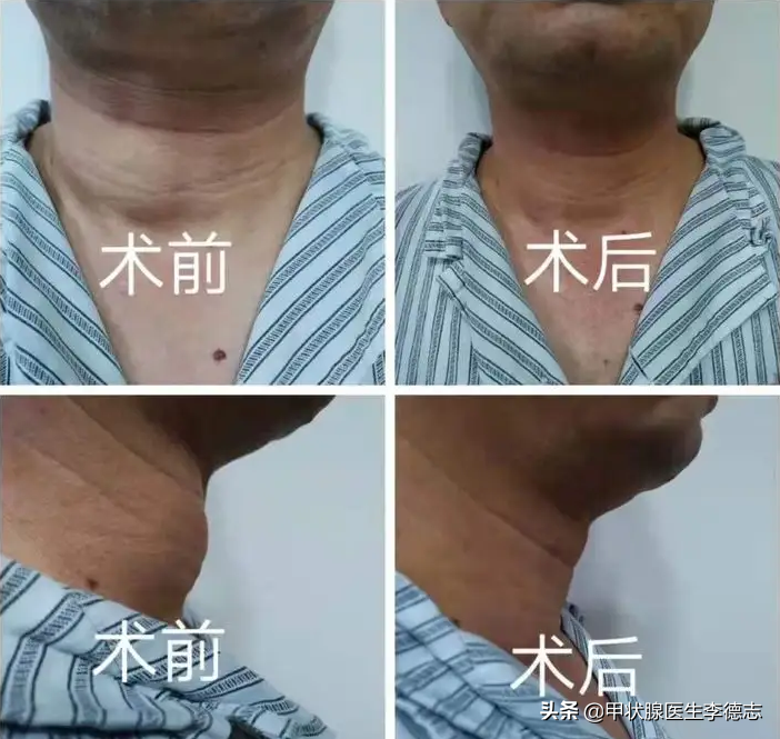 患甲狀腺癌是微創手術還是普通手術醫學界眾說紛紜.