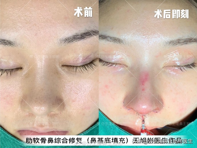 广州隆鼻科普：王旭彬鼻整形修复案例分享
