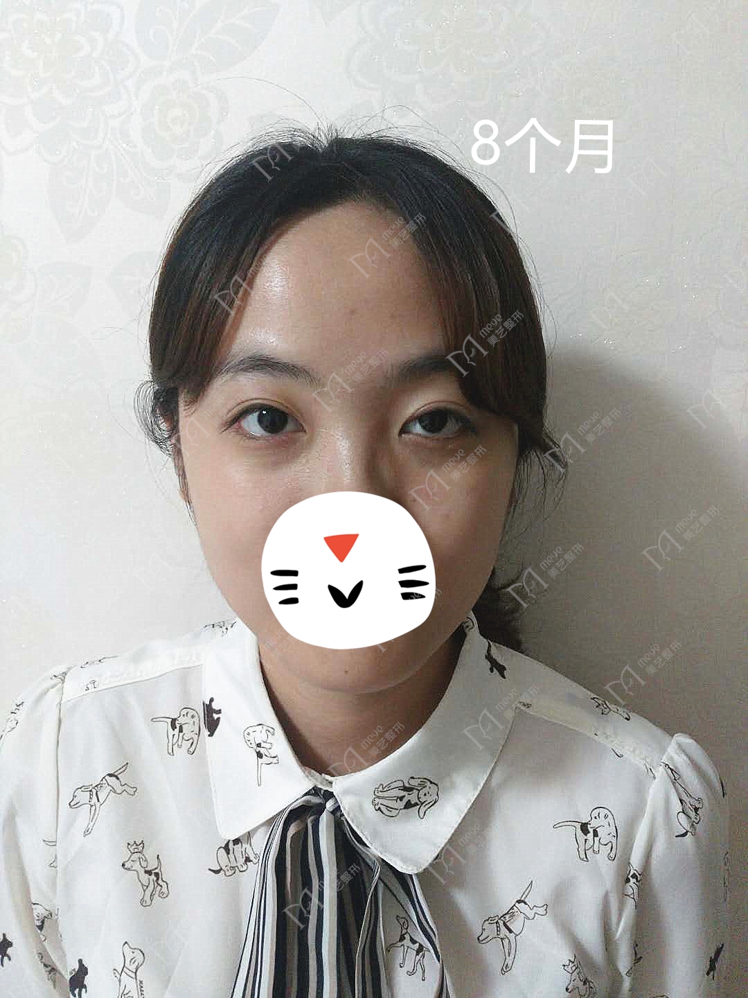 東北小姑娘左眼上瞼下垂10年前做過矯正效果不好,來找我們修復了