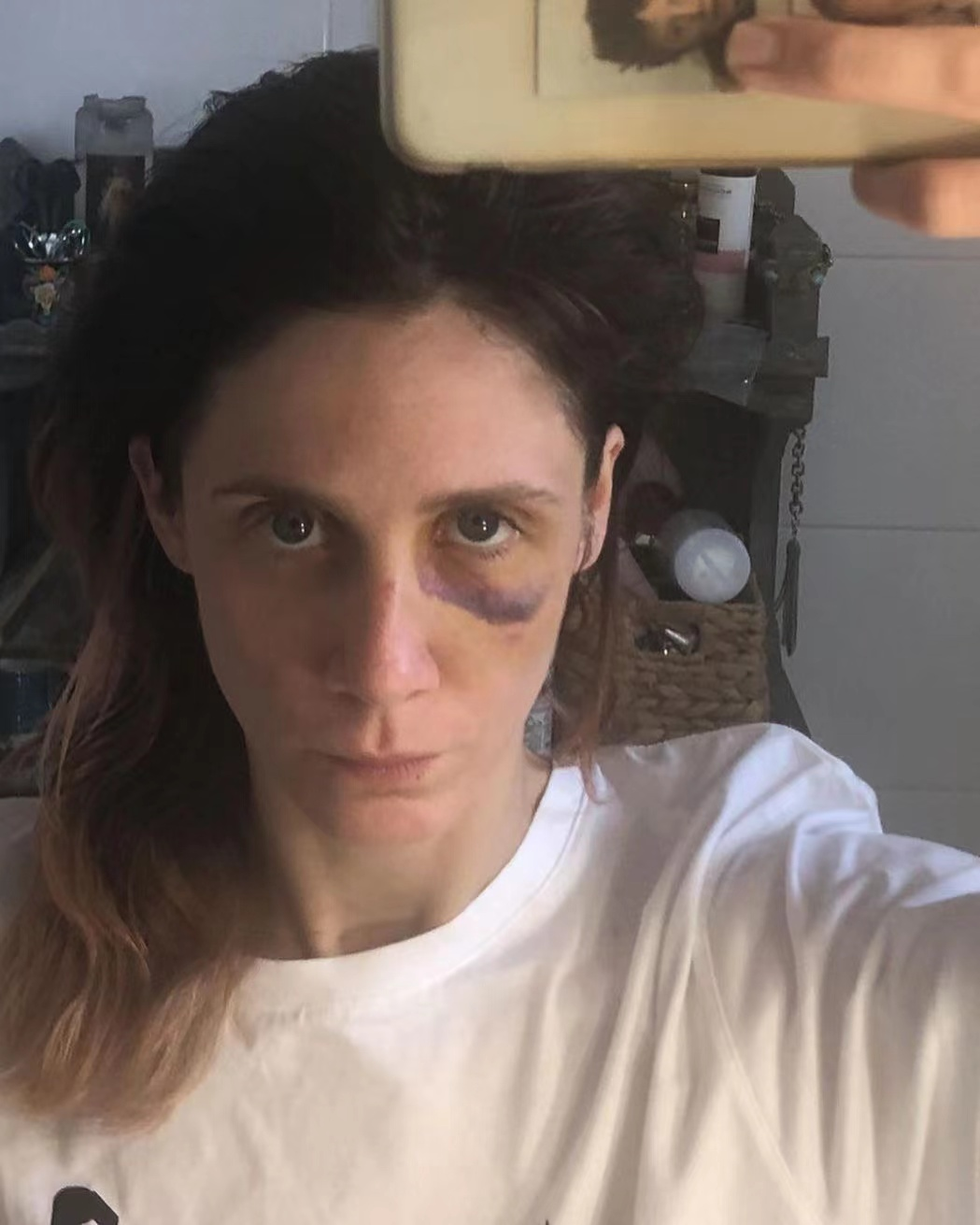 法国女星遭导演前男友家暴，社交平台曝光伤照，脸部青肿让人心疼