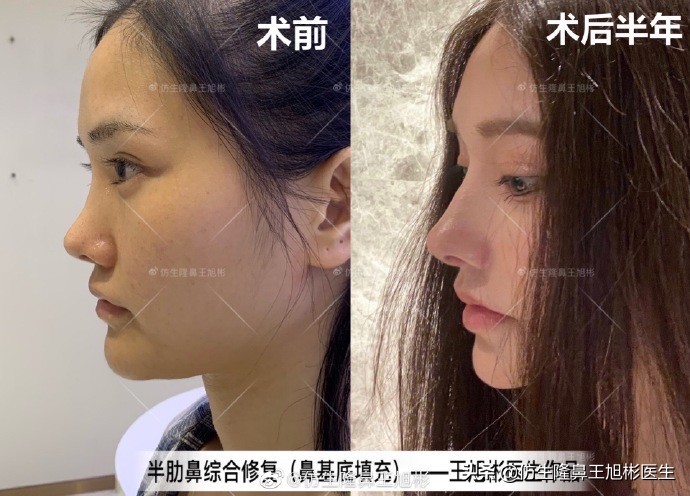 广州隆鼻科普：王旭彬鼻整形修复案例分享