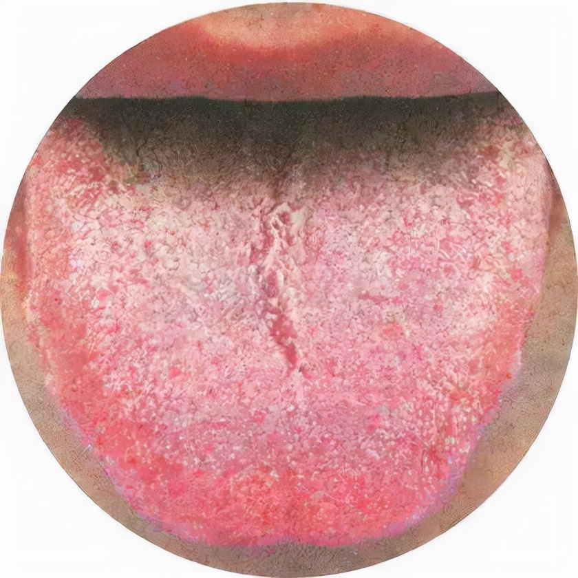 舌苔反映着我们的健康,也是中医辩证常用手段