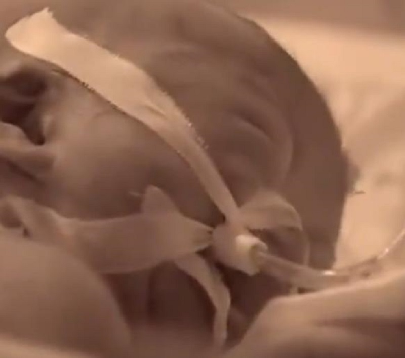 2011年植物人怀孕生子，生产剧痛将她唤醒，女儿出生后丈夫却跑了