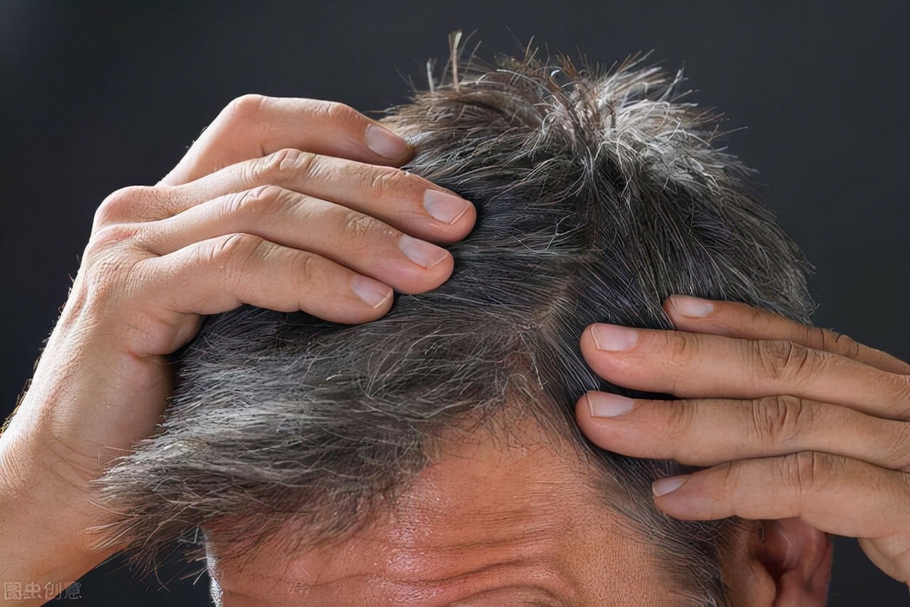 6种常用于斑秃脱发、少白头、头发稀疏的中成药，建议收藏