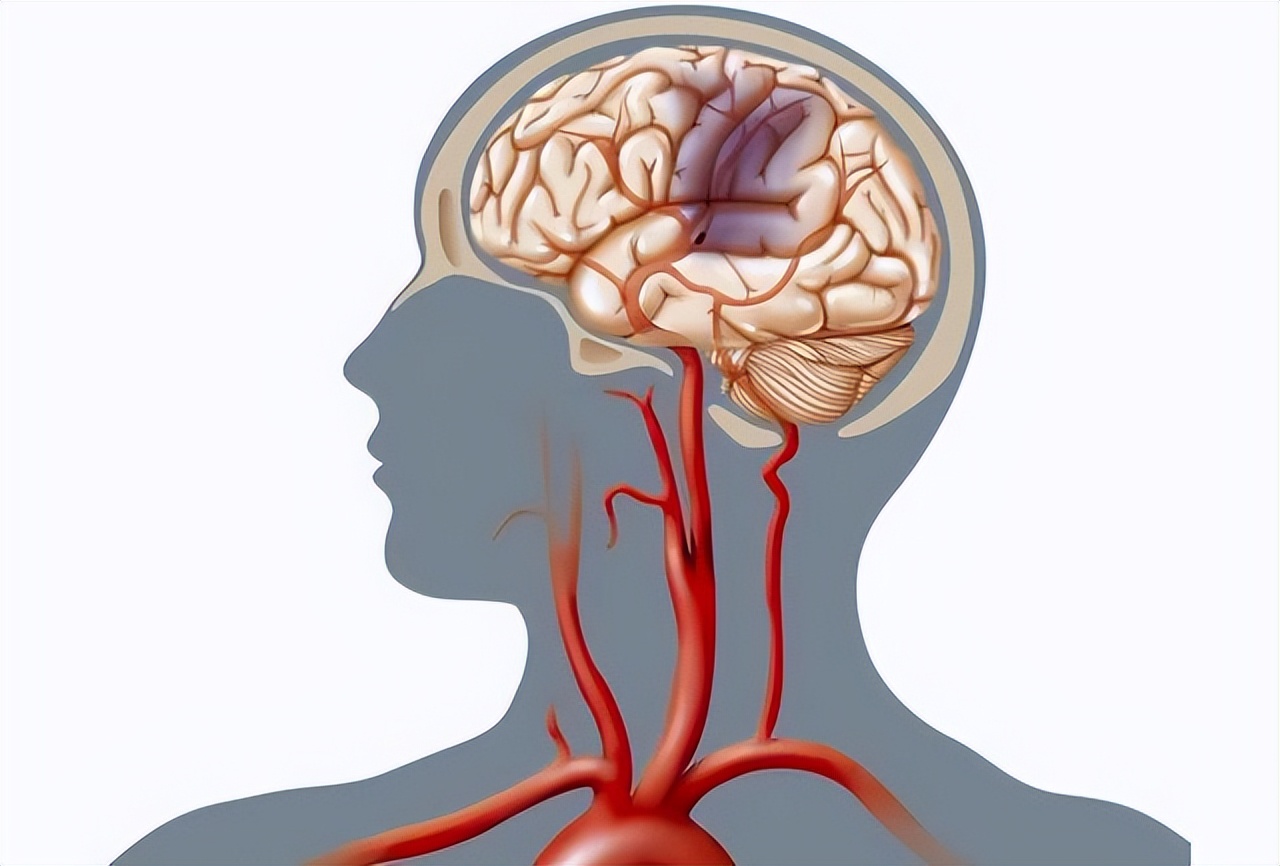 脑梗发生前7-30天，身体或会发出“警告信号”，请别视而不见