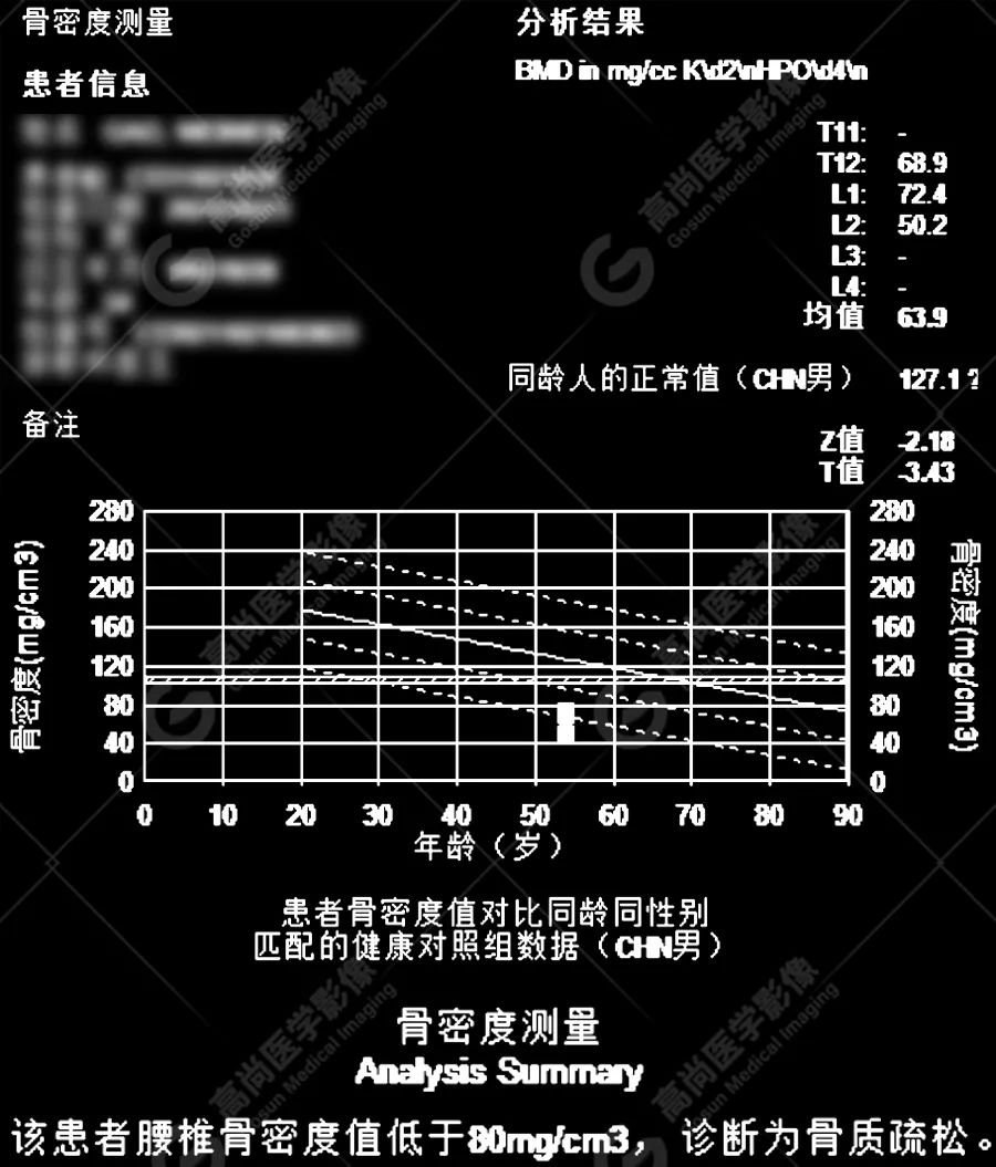 骨密度达到这个数，提醒你要补补钙了？专家为你解答