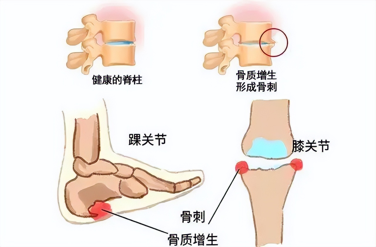 骨刺是骨头长刺了吗？网友：多做运动能不能磨掉？