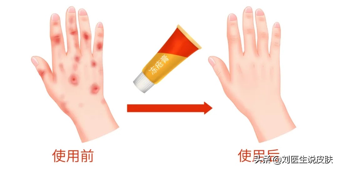 冻疮年年发，又痒又痛！寒冬将至，这份防冻疮攻略很重要（必看）