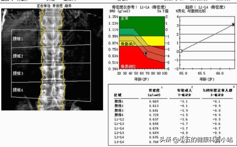 阿仑膦酸钠片是治疗绝经后骨质疏松症的常用药，科学服用注意4点