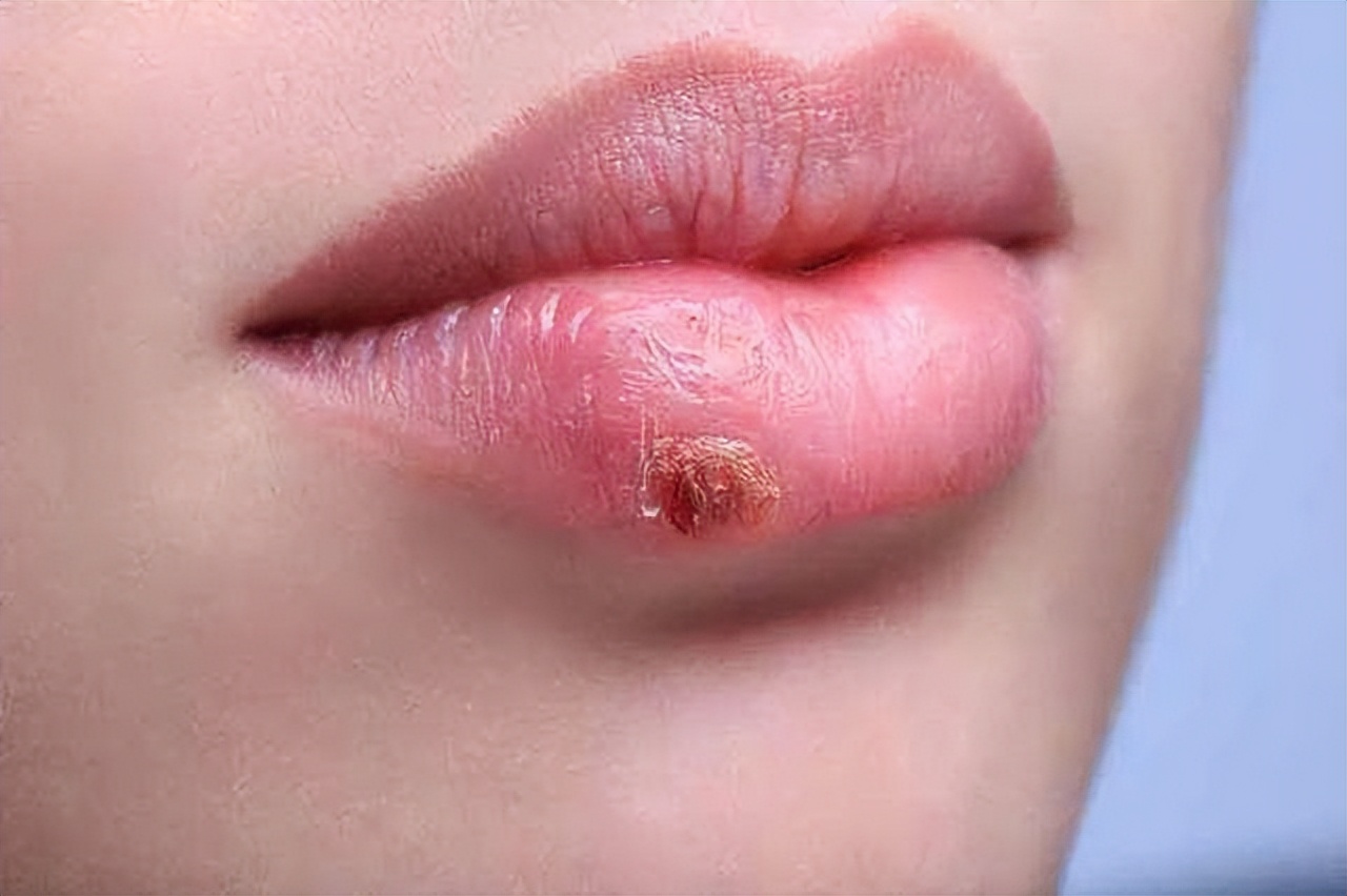 嘴破一定是口腔癌嗎？口腔潰瘍該怎麼處理？