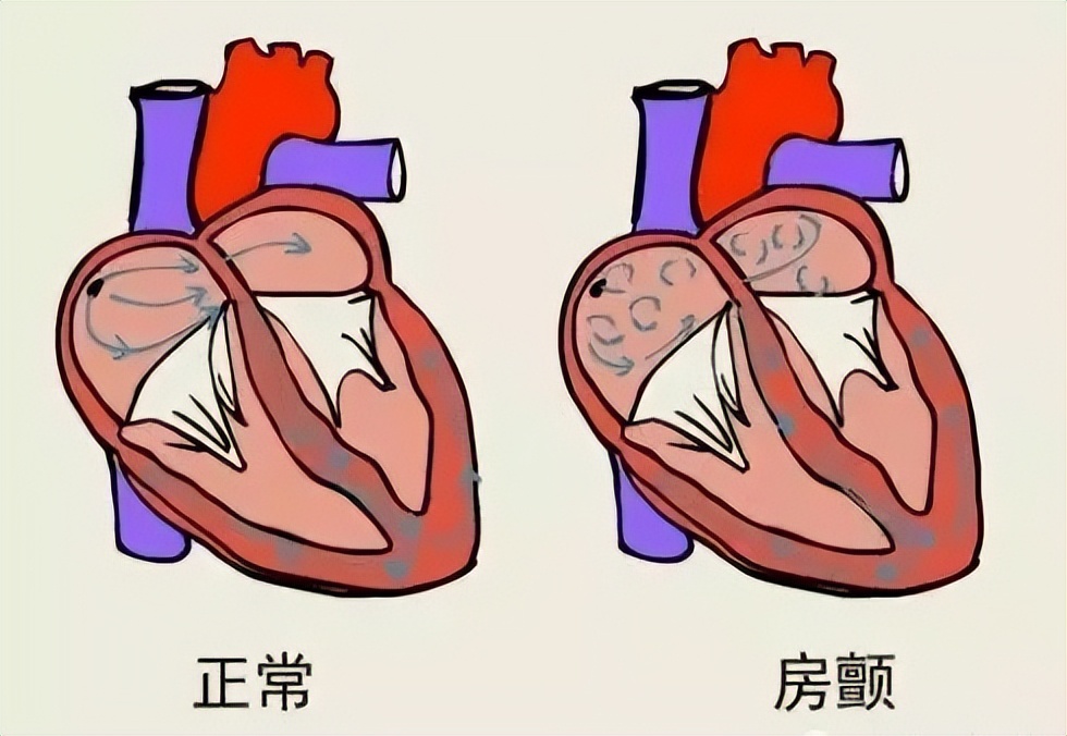 房颤患者可以做骨科手术吗？答案在这里