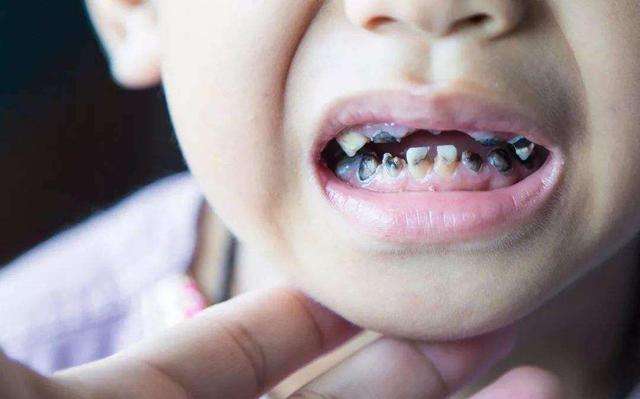 牙齿有黑渍怎么去除(4岁孩子不爱吃糖却满口黑牙) 