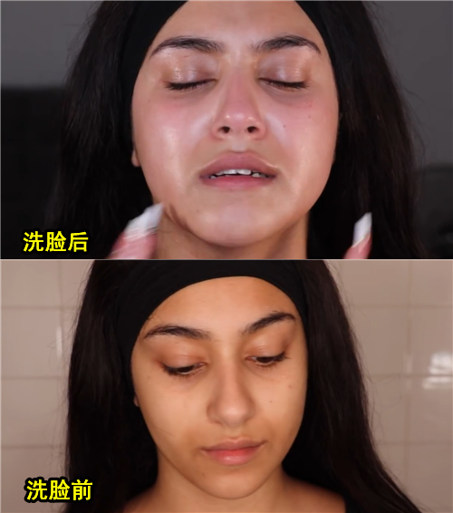 居然有人对水过敏！那该怎么洗澡、喝水、上厕所？