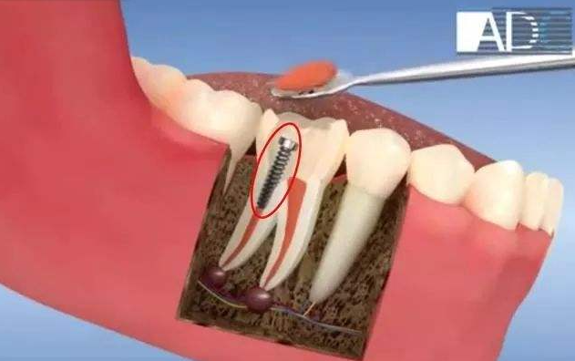 大医院都不建议打牙桩？根管治疗后不建议打桩