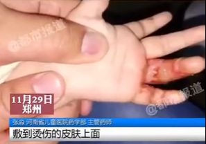 10个月女婴，被家人刮痧毁了脸