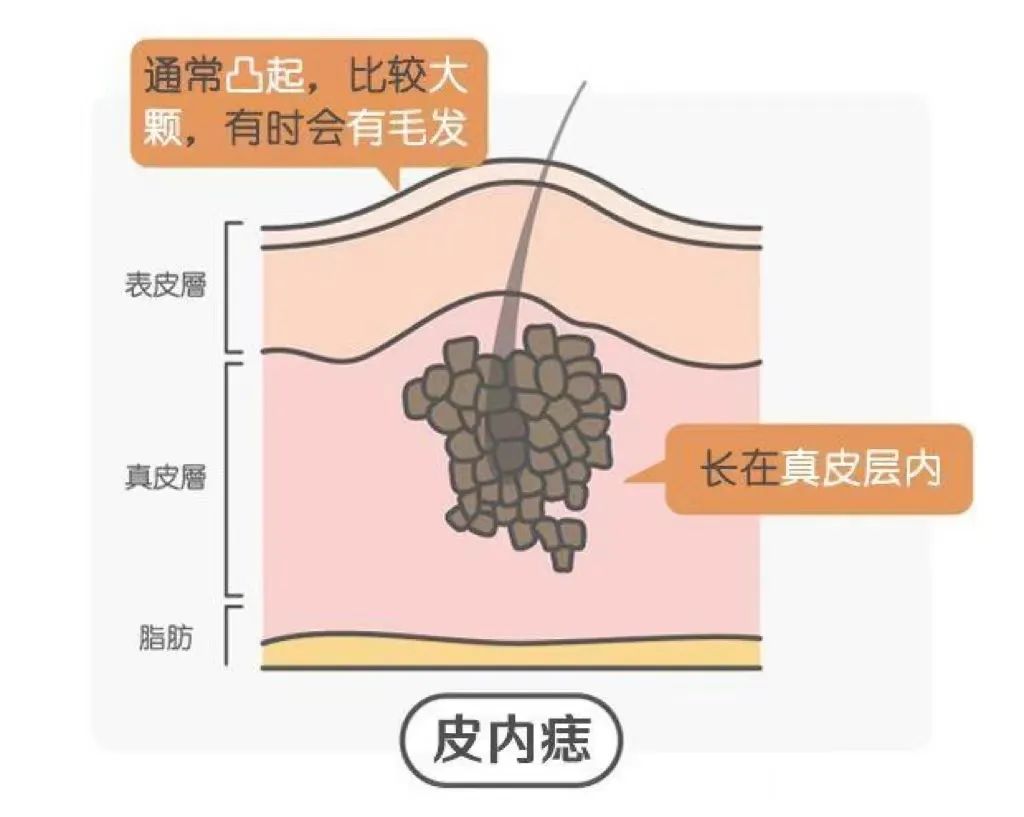 长在这里的痣不能随便点！搞不好会要命