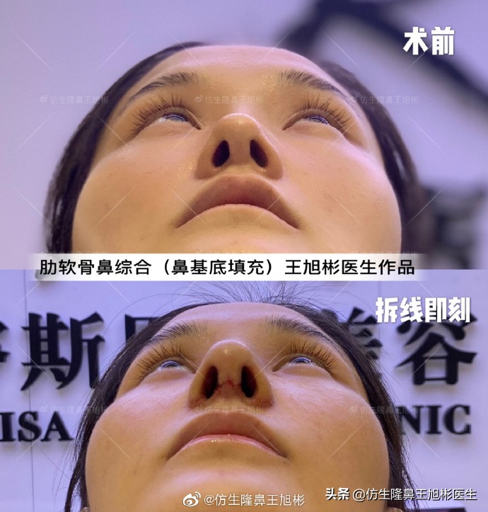 广州隆鼻科普：王旭彬鼻整形修复案例分享