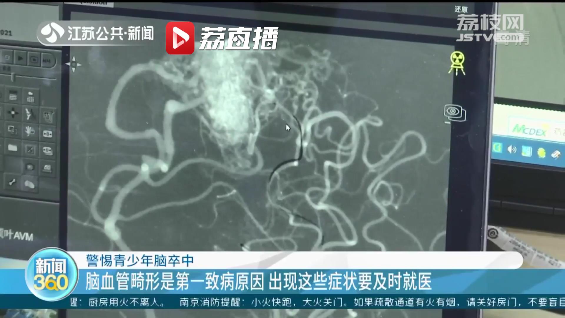 警惕青少年脑卒中 出现症状要及时就医