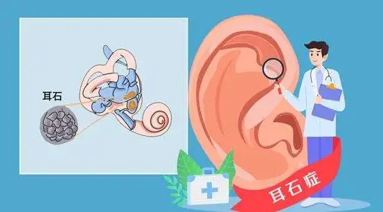 晕从耳中来：小心耳朵里“疯狂的石头”，医生来剖析耳石症