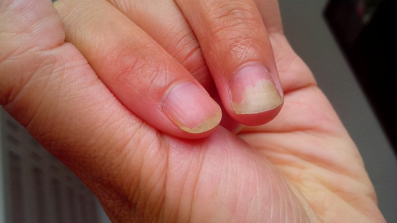 手指甲为什么会出现“竖纹”？指甲常出现的几个问题，建议了解下