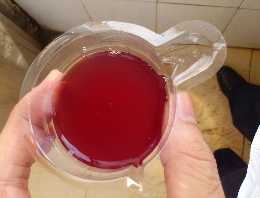 怀孕期间,孕妇发现自己的尿液是"红色"的,顿时吓得不轻