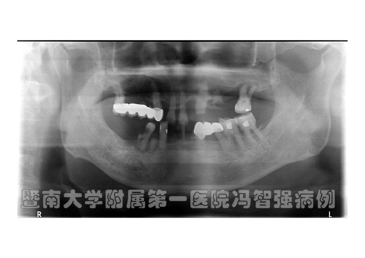 多病纏身的帕金森患者也能種牙？精準種植使八旬老人重獲好牙