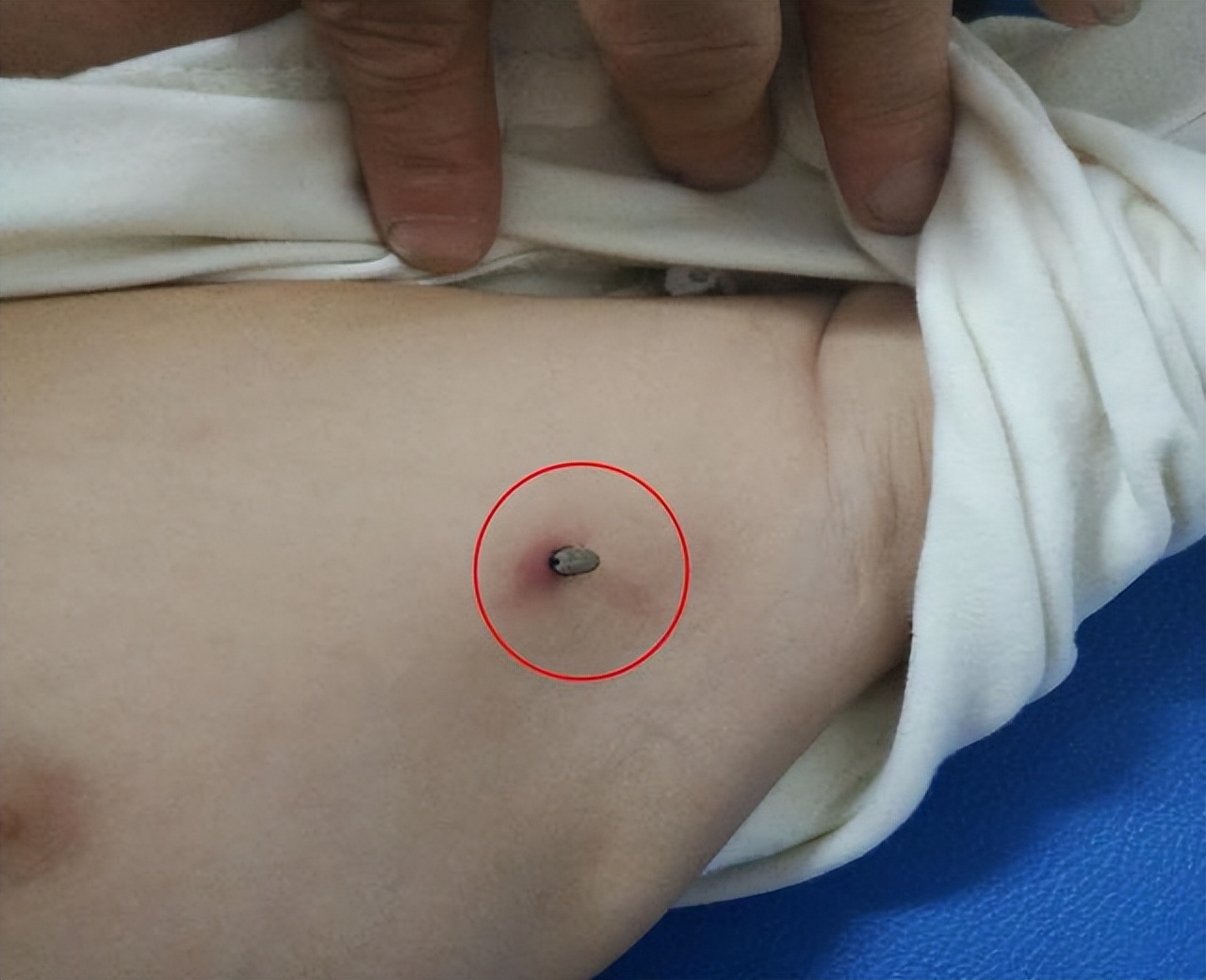 蜱虫夏季蜱虫病太可怕