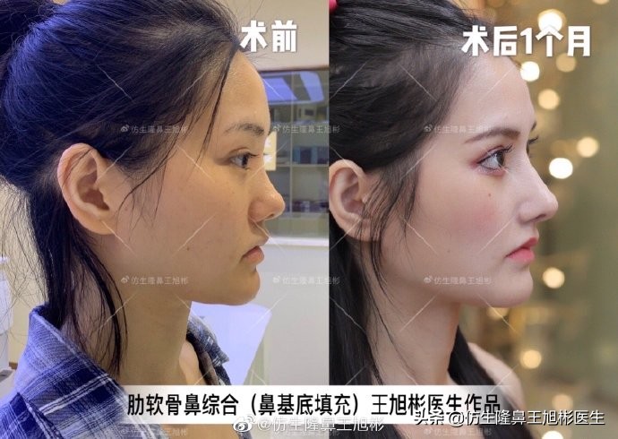 广州隆鼻科普：王旭彬鼻整形修复案例分享