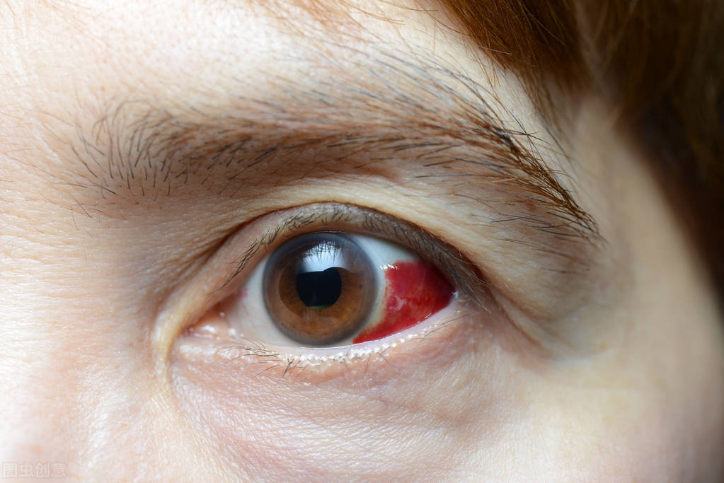 川崎病眼球发红图片图片