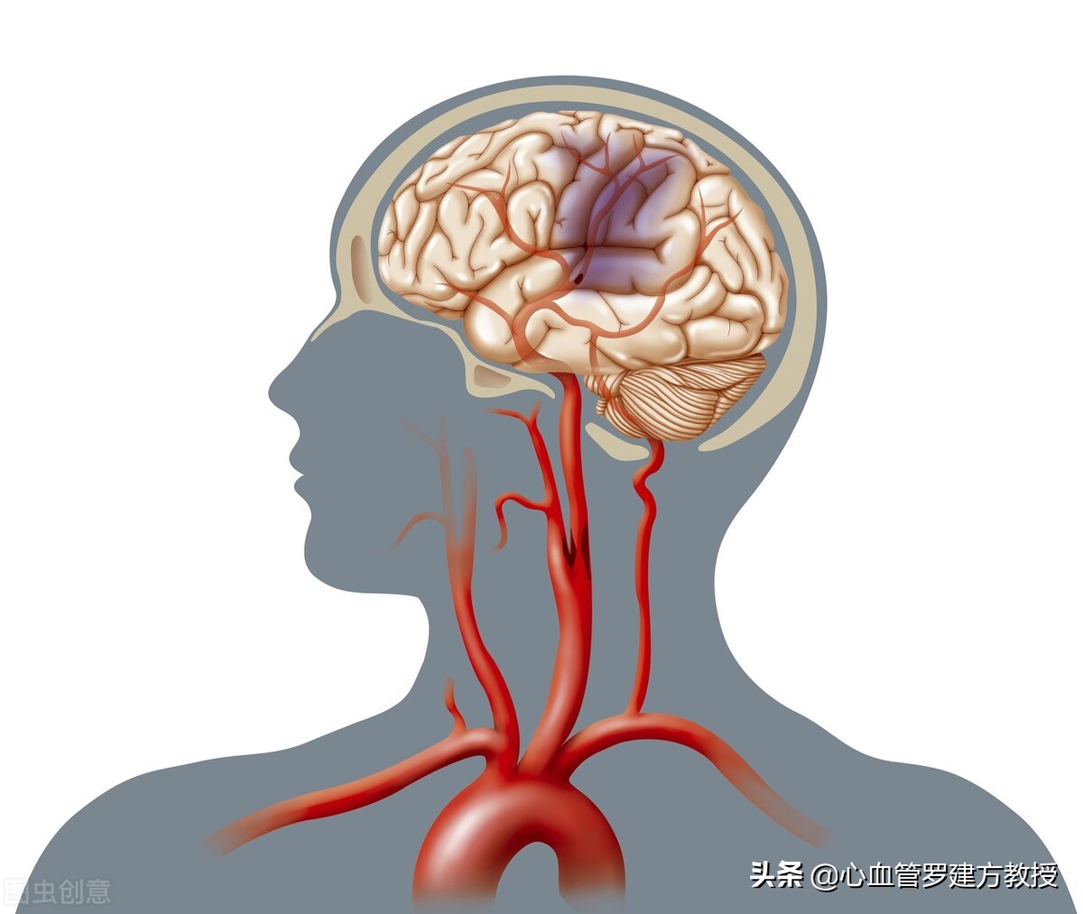 做颈动脉超声检查发现有斑块，该怎么办？如何预防？