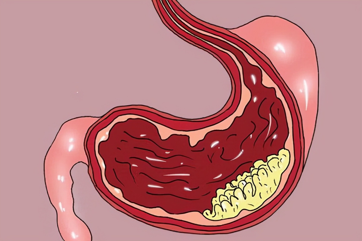 做过胃肠镜的人为什么不想再做第2次，为什么会让人如此拒绝？