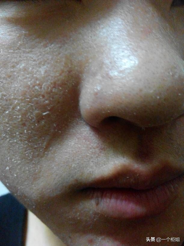 脸上起皮和白色碎屑怎么办(脸上起皮和白色碎屑发红)-我的快乐小窝