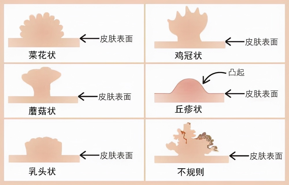 都安全 | 怀疑老公出轨染病，其实小孩也会得尖！锐！湿！疣