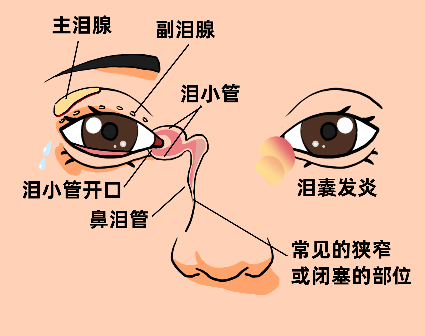 62岁老人手动排眼泪15年,眼角长大脓包引发急性泪囊炎