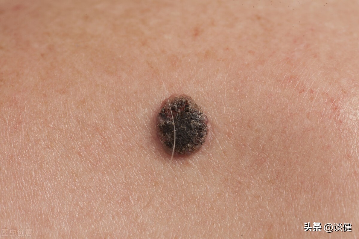 黑色素瘤不痛不痒致死率极高！提醒：老年人皮肤出现5状况应当心