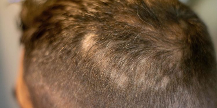 秃头者的福音,科学家发现刺激头发生长分子,小白鼠已实验成果