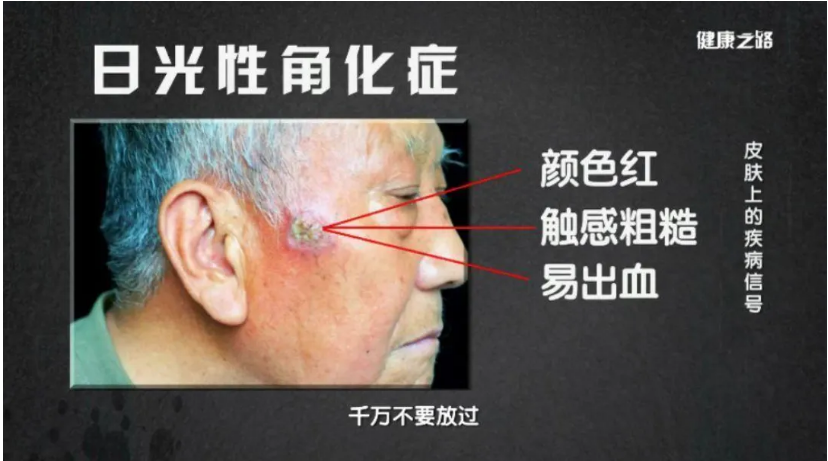 皮肤若是出现4种异常，或是癌症找上门来了，请及时检查