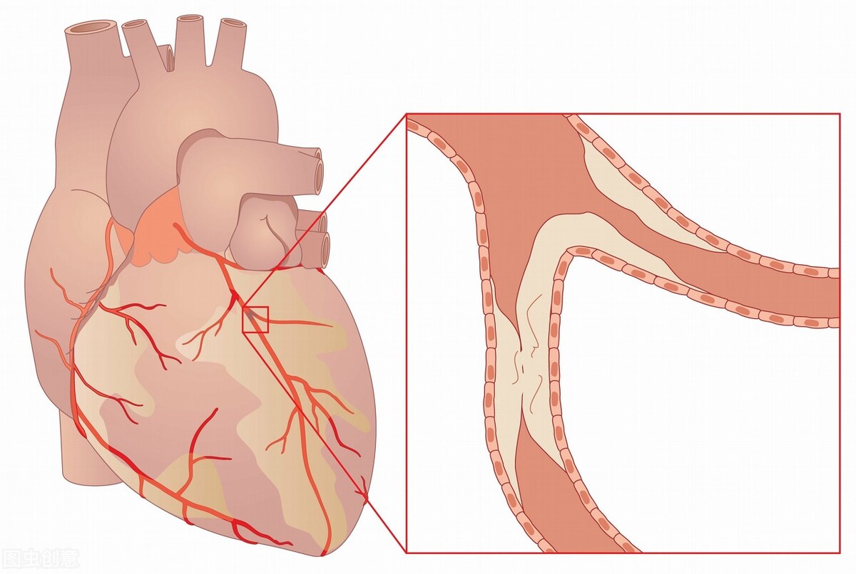 心脏超声检查能发现哪些疾病？怀疑冠心病，能做心脏超声确诊吗？