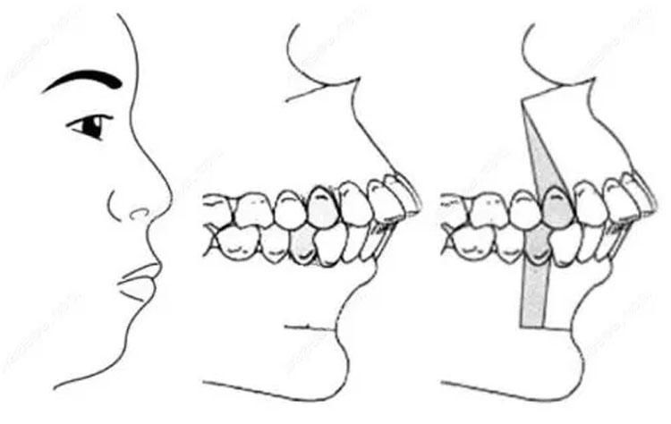 比“法令纹”更可怕的是“嘴凸”，显老苦相又土气，太多人遭殃了