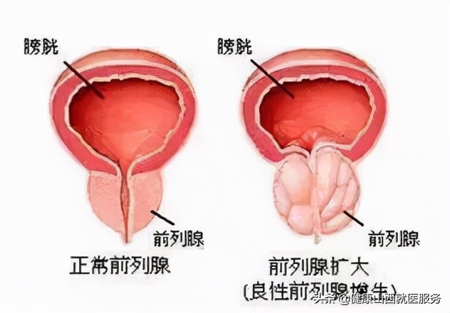尿频、尿急、尿痛别怪肾不好！可能是你的下面生病了