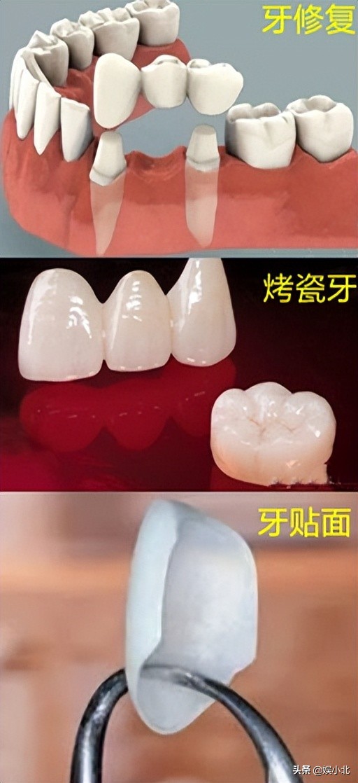 说刘亦菲牙齿丑的，是烤瓷牙看多了吧？