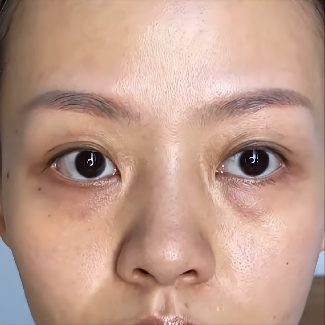 泪沟是什么(泪沟填充是什么)