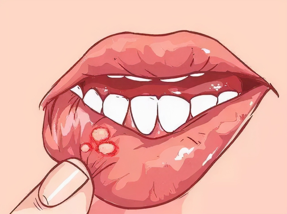 口腔溃疡怎么办最快愈合，溃疡止痛的妙招详解？