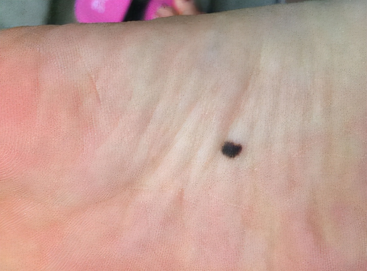 嘴唇嘴上长出黑痣,一定要考虑是否大肠癌出现,对于黑斑息肉综合症