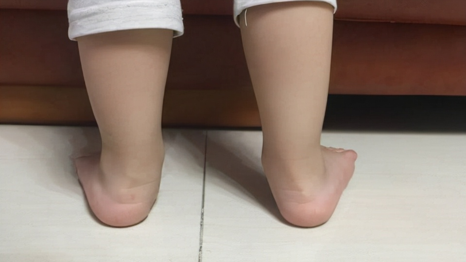 如果你也发现,孩子的小脚有意无意地向外翻,鞋底跟后侧也出现了磨损