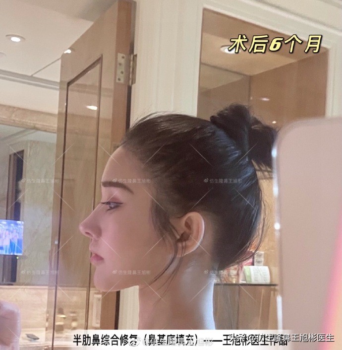 广州隆鼻科普：王旭彬鼻整形修复案例分享