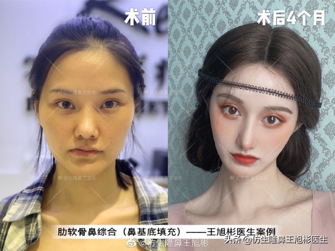 广州隆鼻科普：王旭彬鼻整形修复案例分享