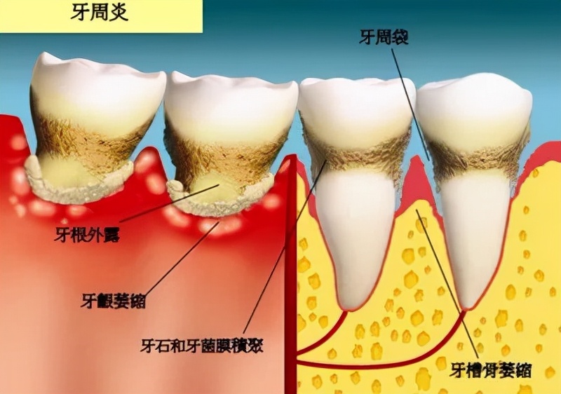 成年人牙齿松了怎么办（牙齿松动的原因及防治方法）