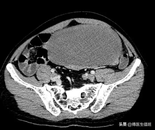 男子腰背部疼痛，就医发现腹腔占位，手术中护士惊呼：太少见了