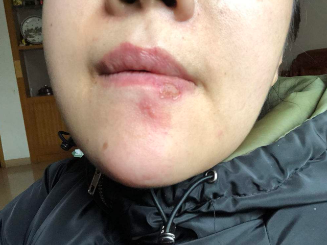 口周湿疹图片(嘴巴周围经常出现) - 赤虎壹号